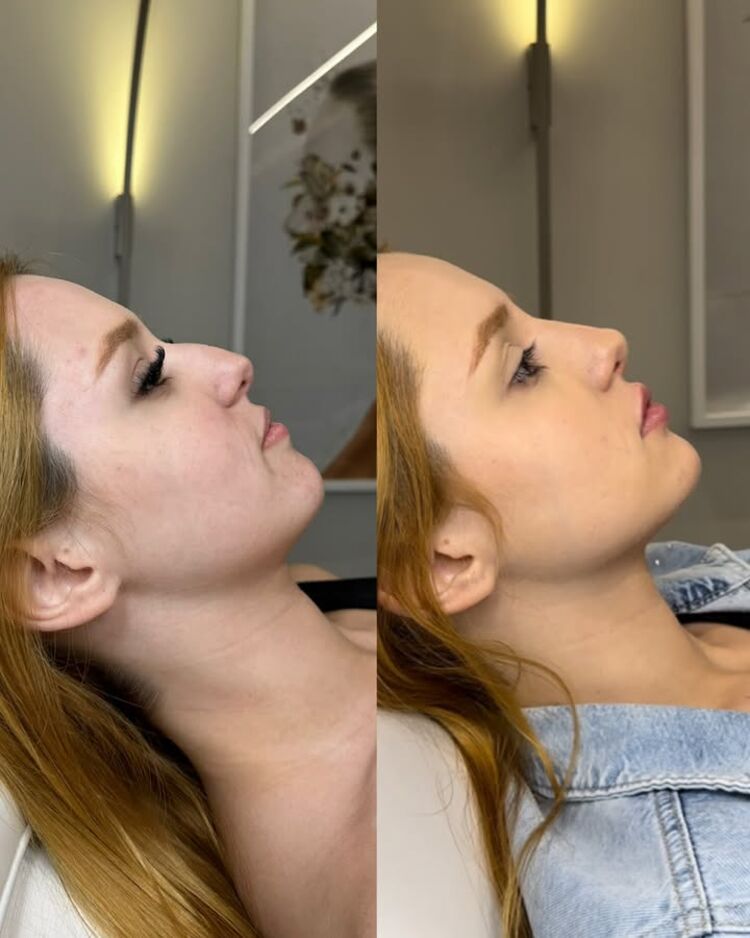 Resultado: Perfiloplastia - Perfil refinado com proporção entre nariz, queixo e lábios