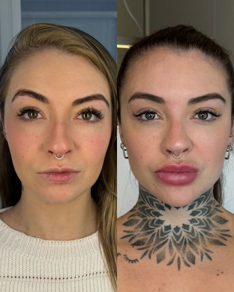 Resultado: Harmonização Full Face - Mais sustentação e leveza no contorno facial